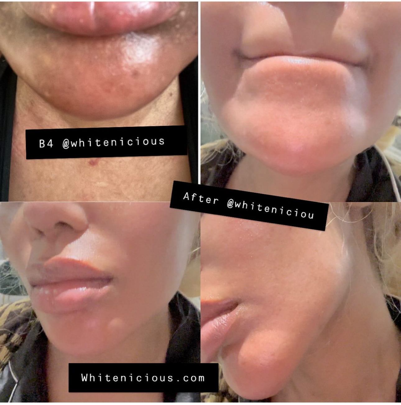 WHITENICIOUS X BLAC CHYNA
SPHYNX SKIN.
Vanishing act Darkspot Eraser