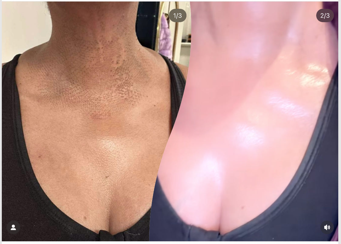 WHITENICIOUS X BLAC CHYNA       
            SPHYNX  SKIN. 
                                                                Vanishing act Darkspot Eraser