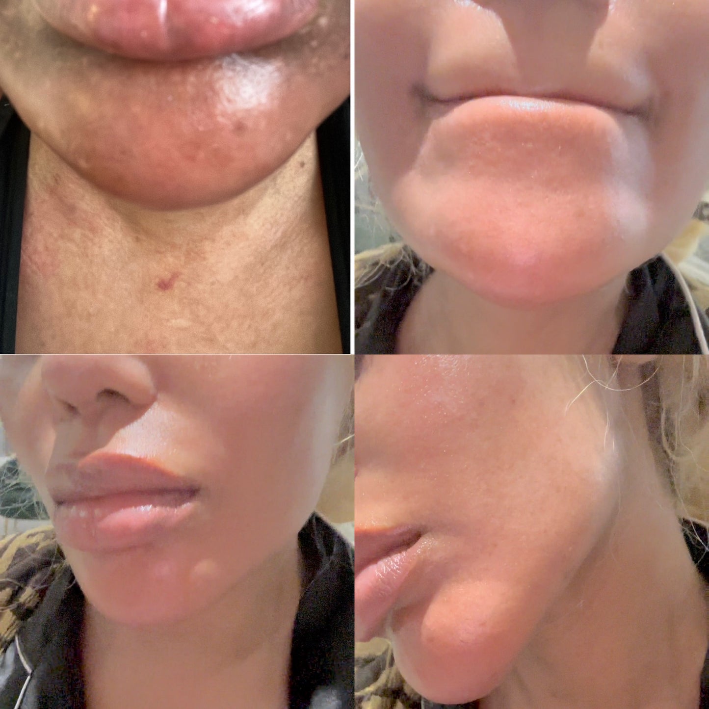 Darkspot Remover Set.                            Blac Chyna